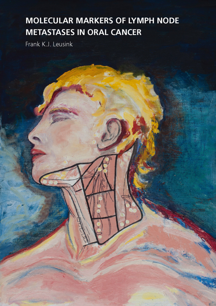 Molecular markers of lymph node metastases in oral cancer