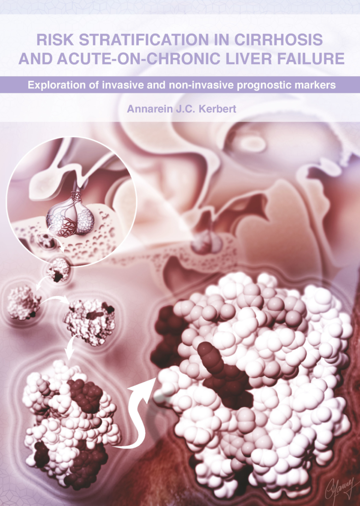 Risk stratification in cirrhosis and acute-on-chronic liver failure