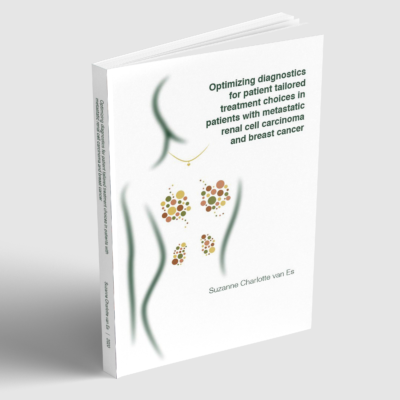 Optimizing diagnostics for patient tailored treatment choices in patients with metastatic renal cell carcinoma and breast cancer
